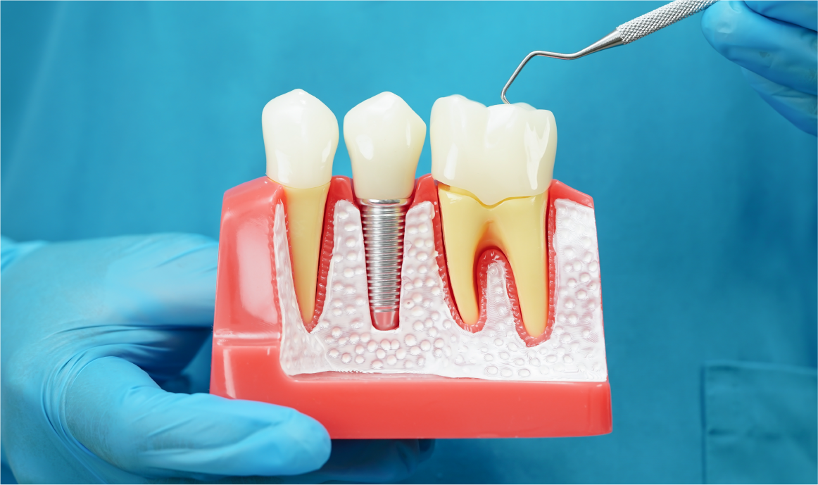 Tratamiento de las Patologías y Complicaciones Periimplantarias