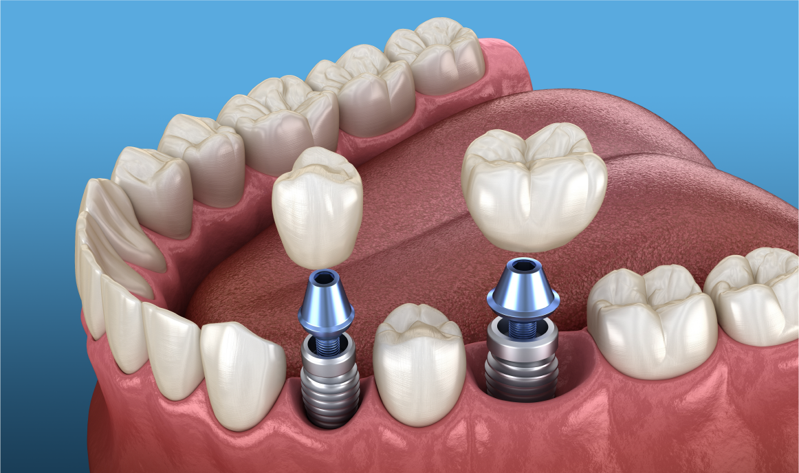 Rehabilitación Oral con Prótesis Sobreimplantes en el Edéntulo Parcial