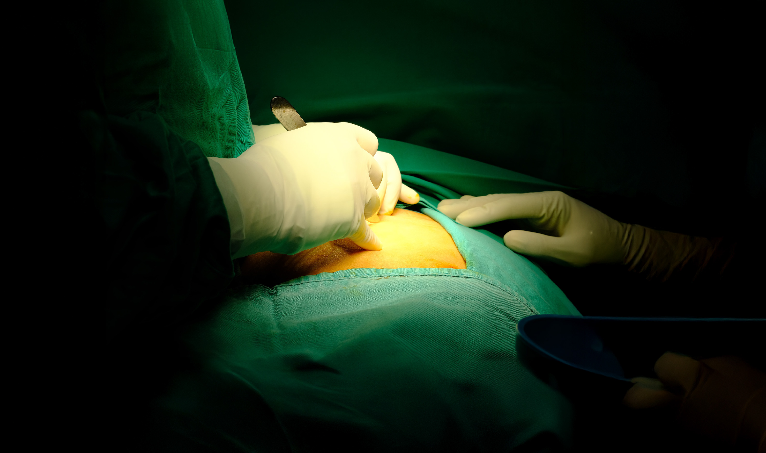 Taller de Cirugía de Hernias y Pared Abdominal
