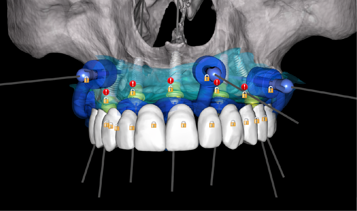 Planificación Digital y Cirugía Guiada en Implantología Oral